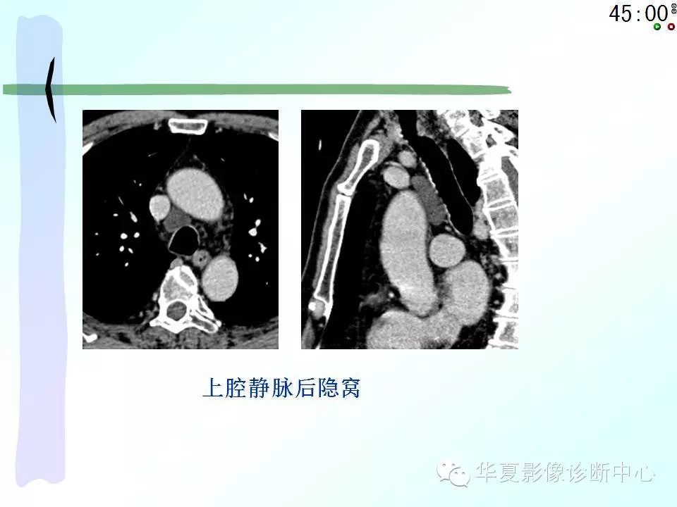 心包隐窝、心包窦的解剖