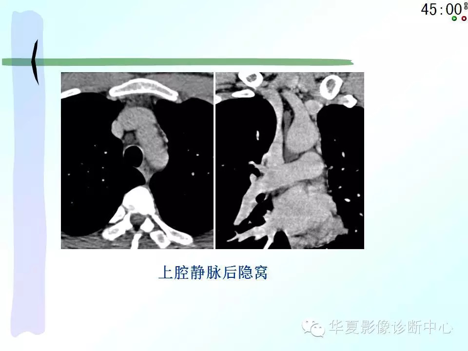 心包隐窝、心包窦的解剖