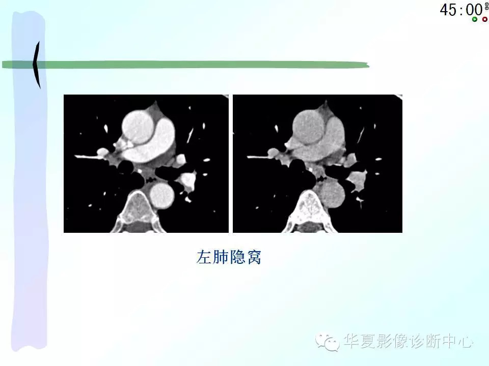 心包隐窝、心包窦的解剖