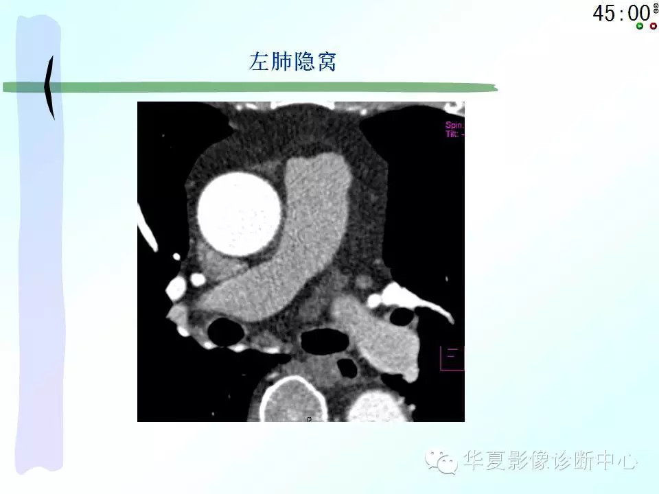 心包隐窝、心包窦的解剖