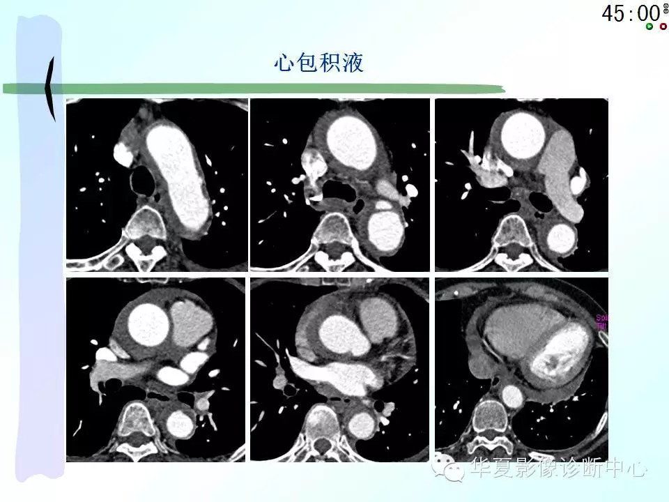 心包隐窝、心包窦的解剖