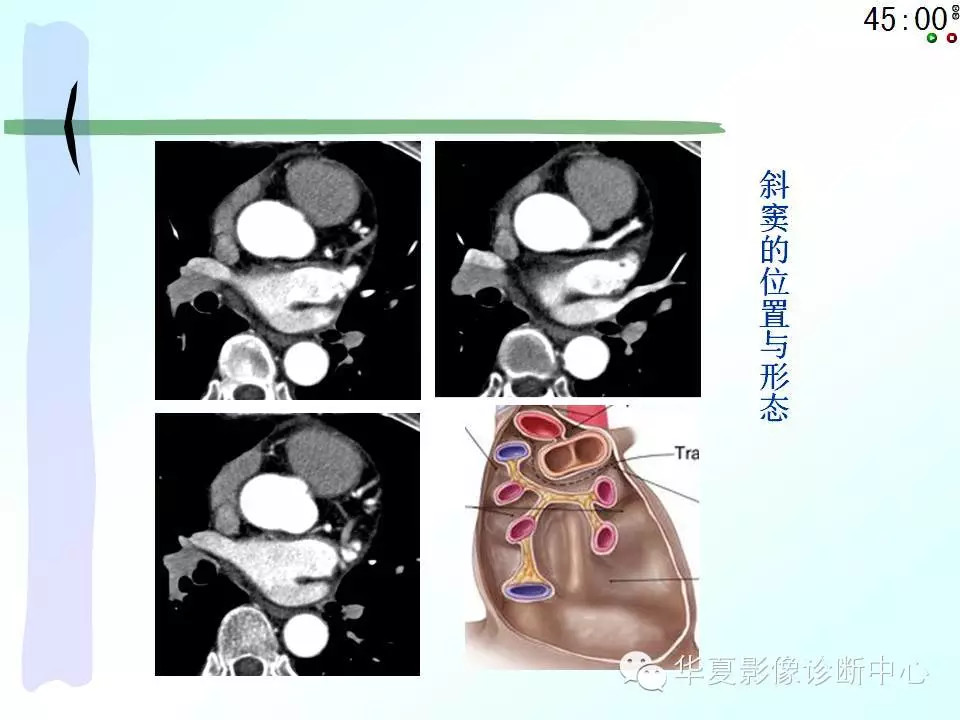 心包隐窝、心包窦的解剖