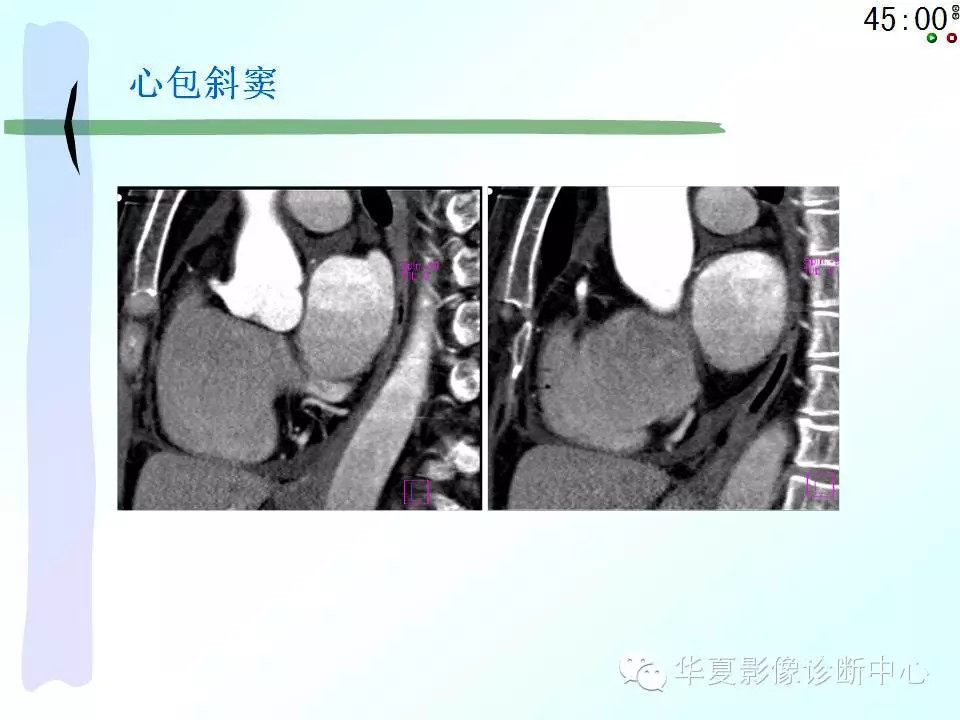 心包隐窝、心包窦的解剖