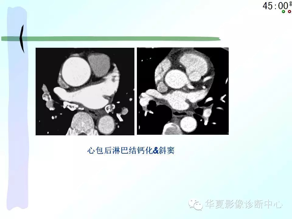 心包隐窝、心包窦的解剖