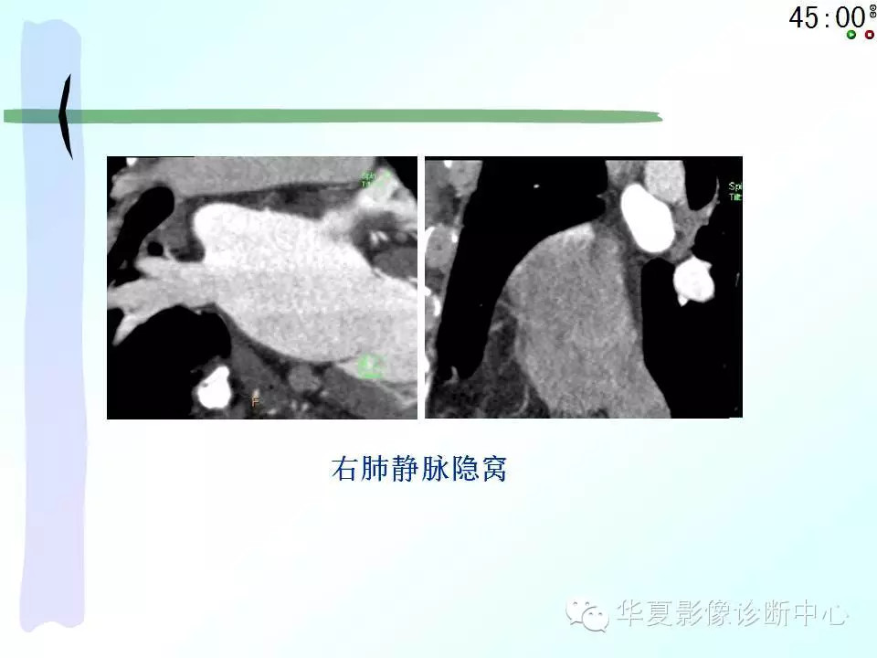 心包隐窝、心包窦的解剖