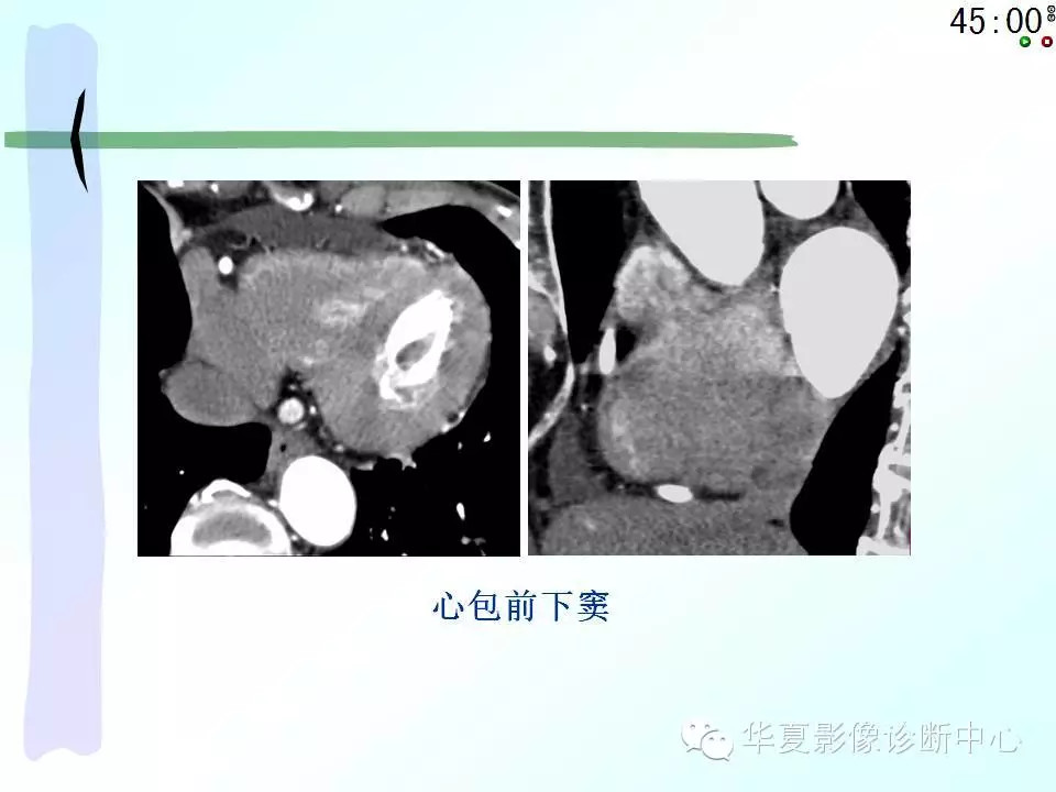 心包隐窝、心包窦的解剖
