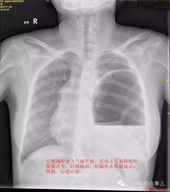 【病例学习】膈疝一例X线诊断
