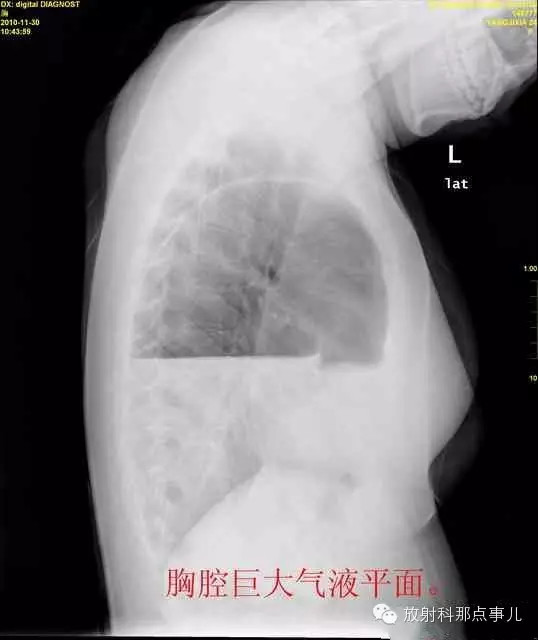【病例学习】膈疝一例X线诊断