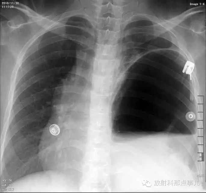 【病例学习】膈疝一例X线诊断