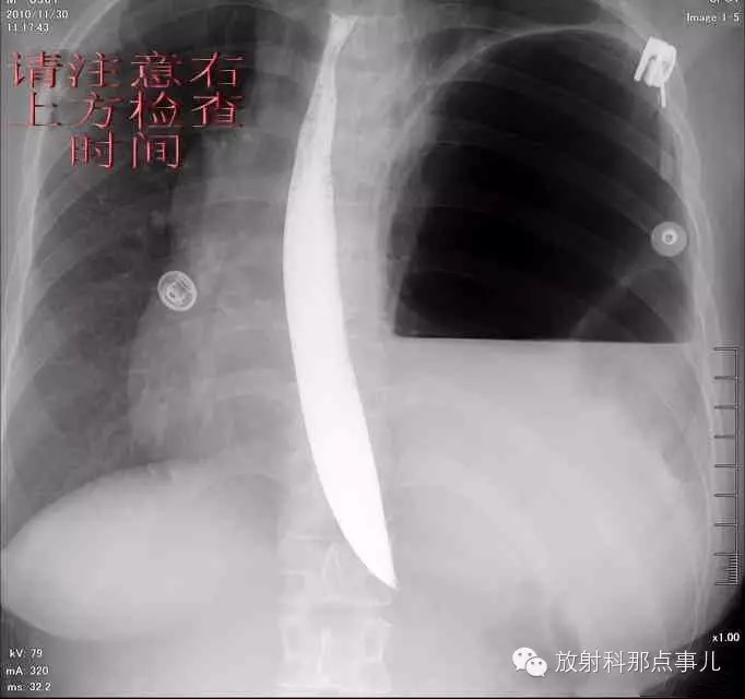 【病例学习】膈疝一例X线诊断