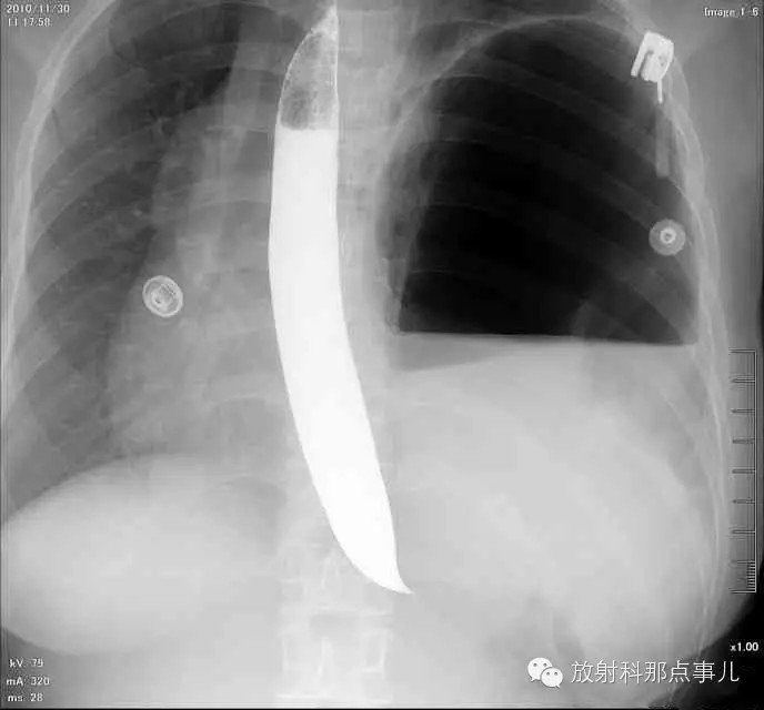 【病例学习】膈疝一例X线诊断