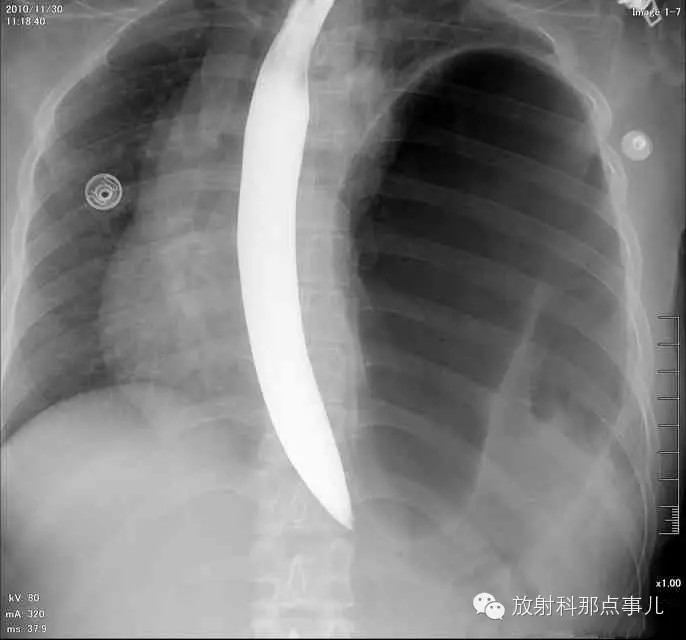 【病例学习】膈疝一例X线诊断