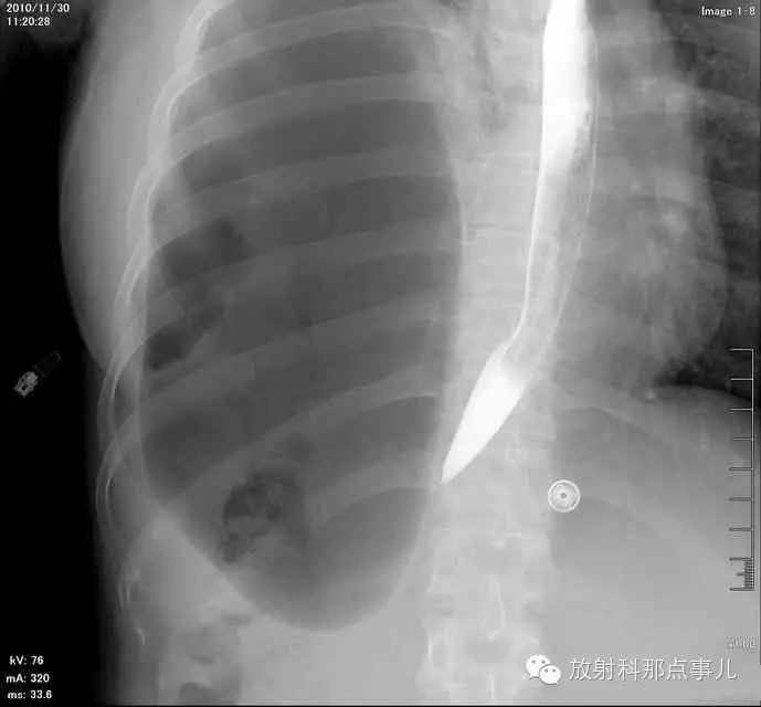 【病例学习】膈疝一例X线诊断