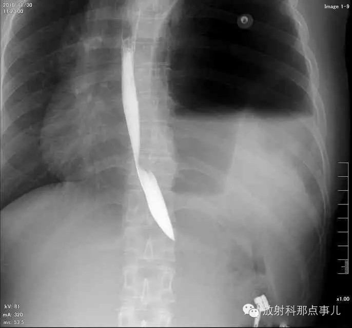 【病例学习】膈疝一例X线诊断