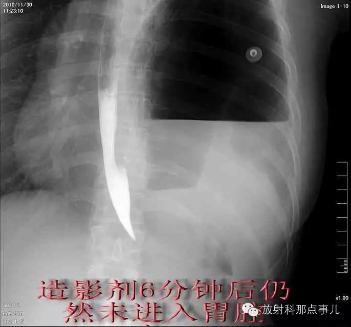 【病例学习】膈疝一例X线诊断
