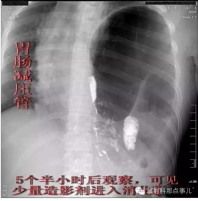【病例学习】膈疝一例X线诊断