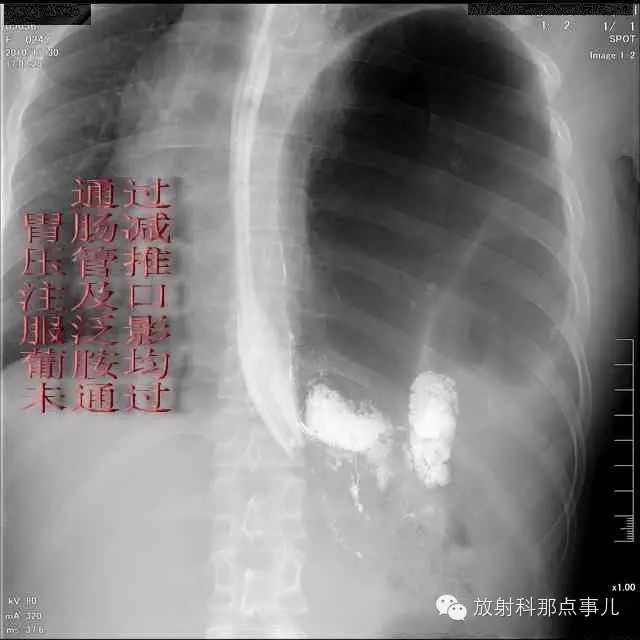 【病例学习】膈疝一例X线诊断