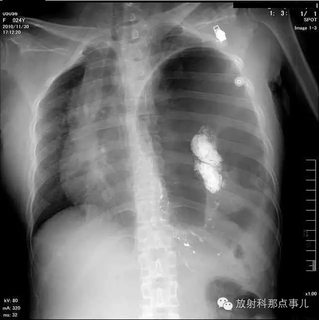【病例学习】膈疝一例X线诊断