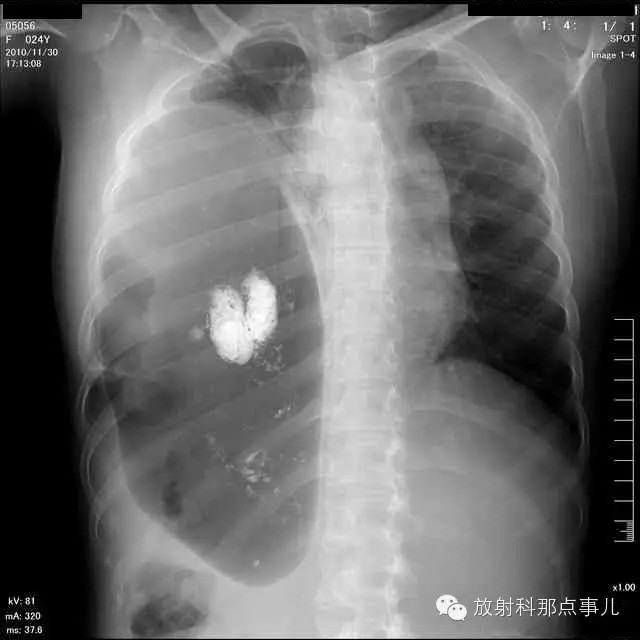 【病例学习】膈疝一例X线诊断