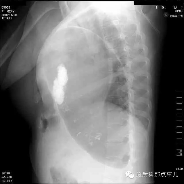 【病例学习】膈疝一例X线诊断