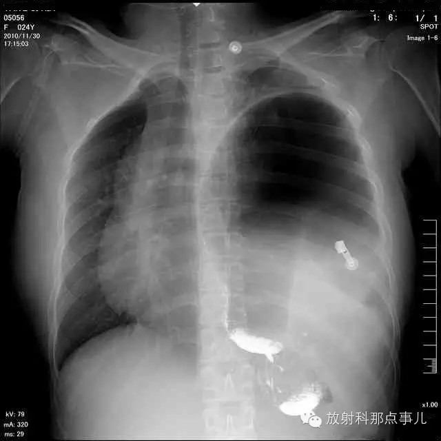 【病例学习】膈疝一例X线诊断
