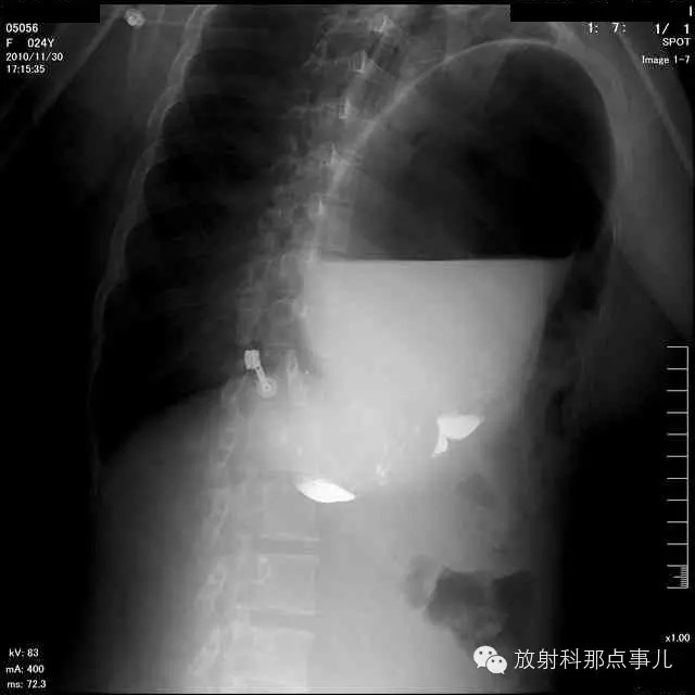 【病例学习】膈疝一例X线诊断