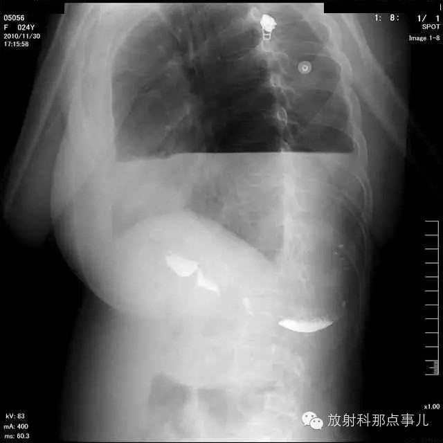 【病例学习】膈疝一例X线诊断