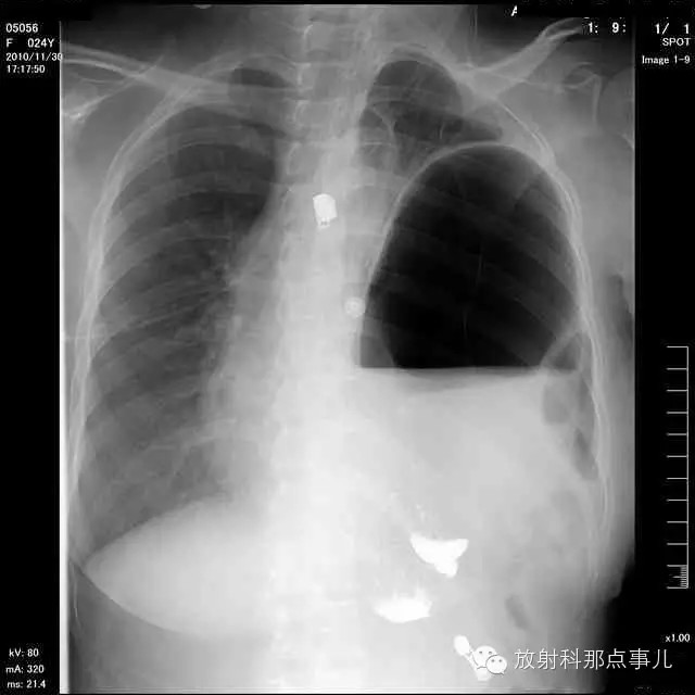 【病例学习】膈疝一例X线诊断