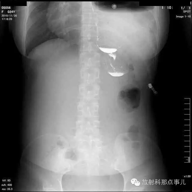 【病例学习】膈疝一例X线诊断