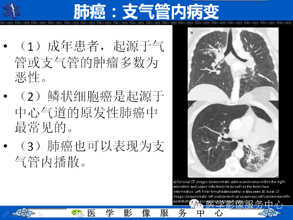 【考考你】哪一个不是肺癌？（共12组病例）