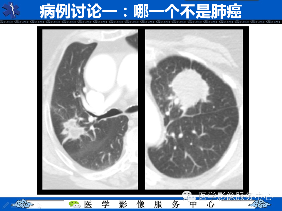 【考考你】哪一个不是肺癌？（共12组病例）