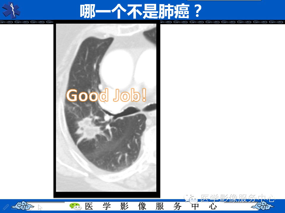 【考考你】哪一个不是肺癌？（共12组病例）