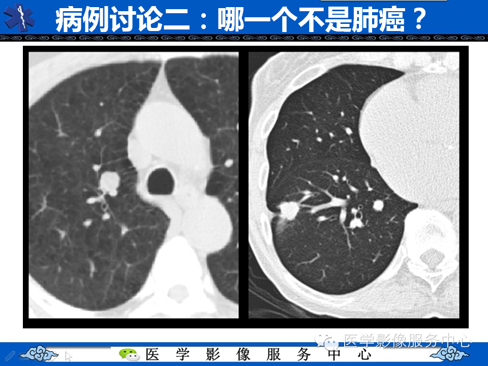 【考考你】哪一个不是肺癌？（共12组病例）