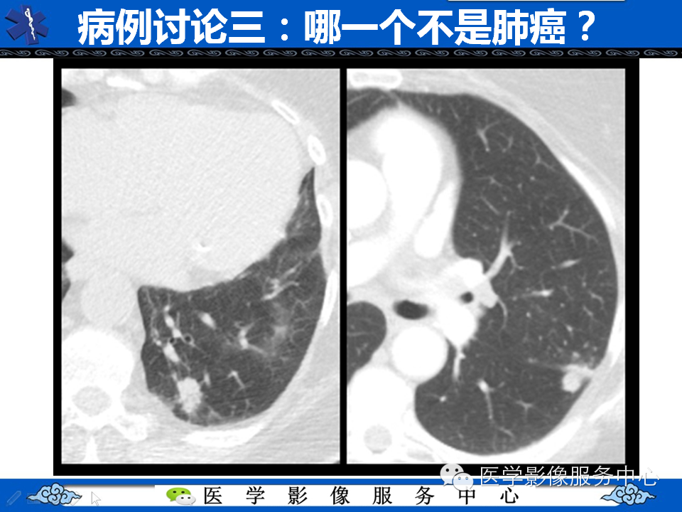【考考你】哪一个不是肺癌？（共12组病例）