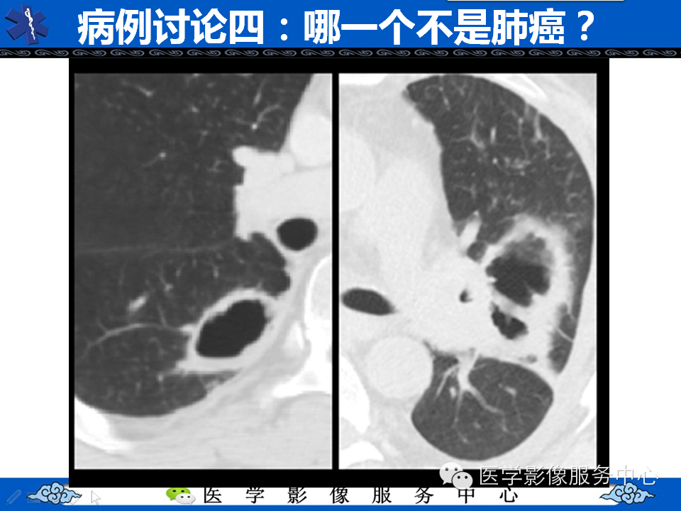 【考考你】哪一个不是肺癌？（共12组病例）