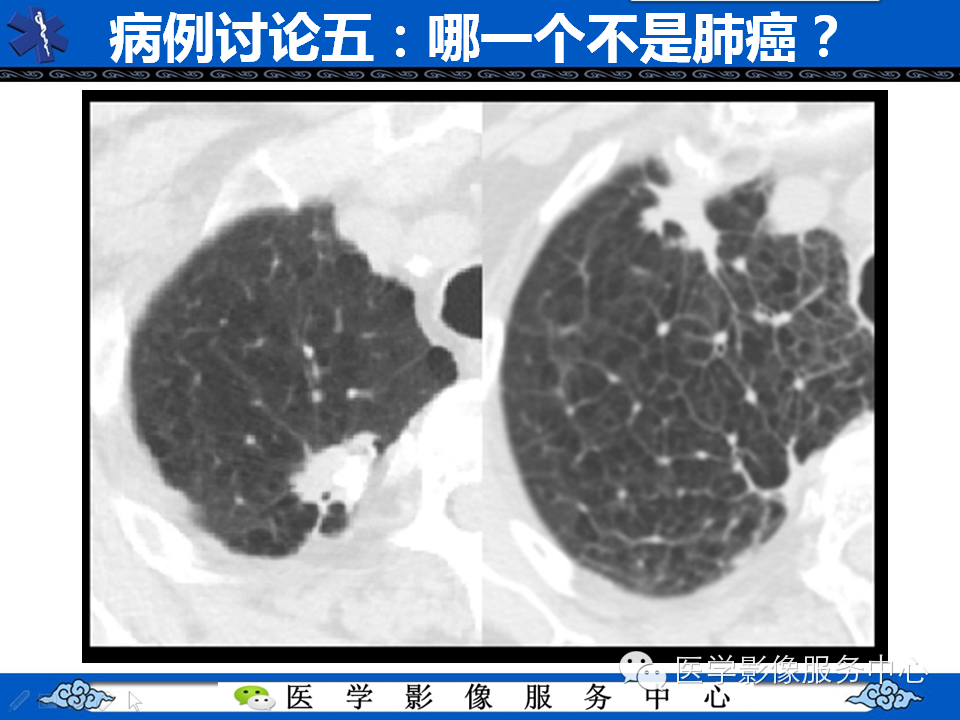 【考考你】哪一个不是肺癌？（共12组病例）