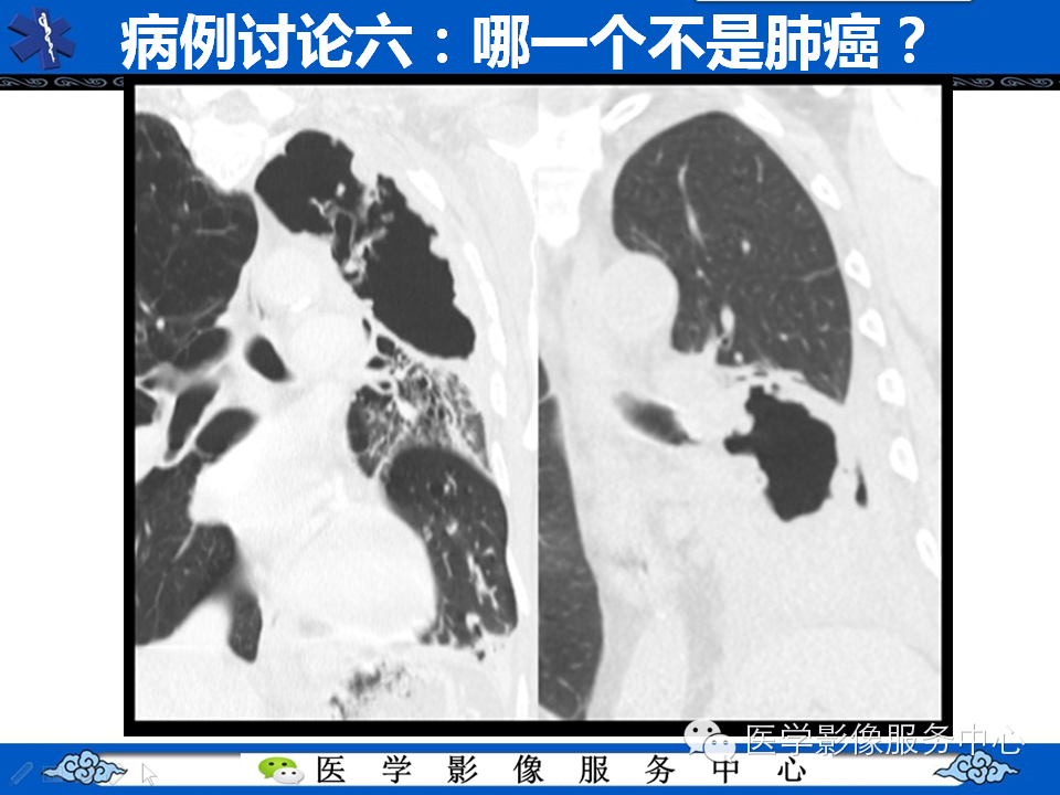 【考考你】哪一个不是肺癌？（共12组病例）