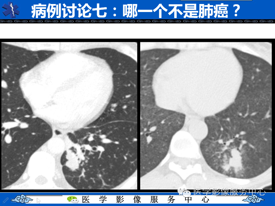 【考考你】哪一个不是肺癌？（共12组病例）