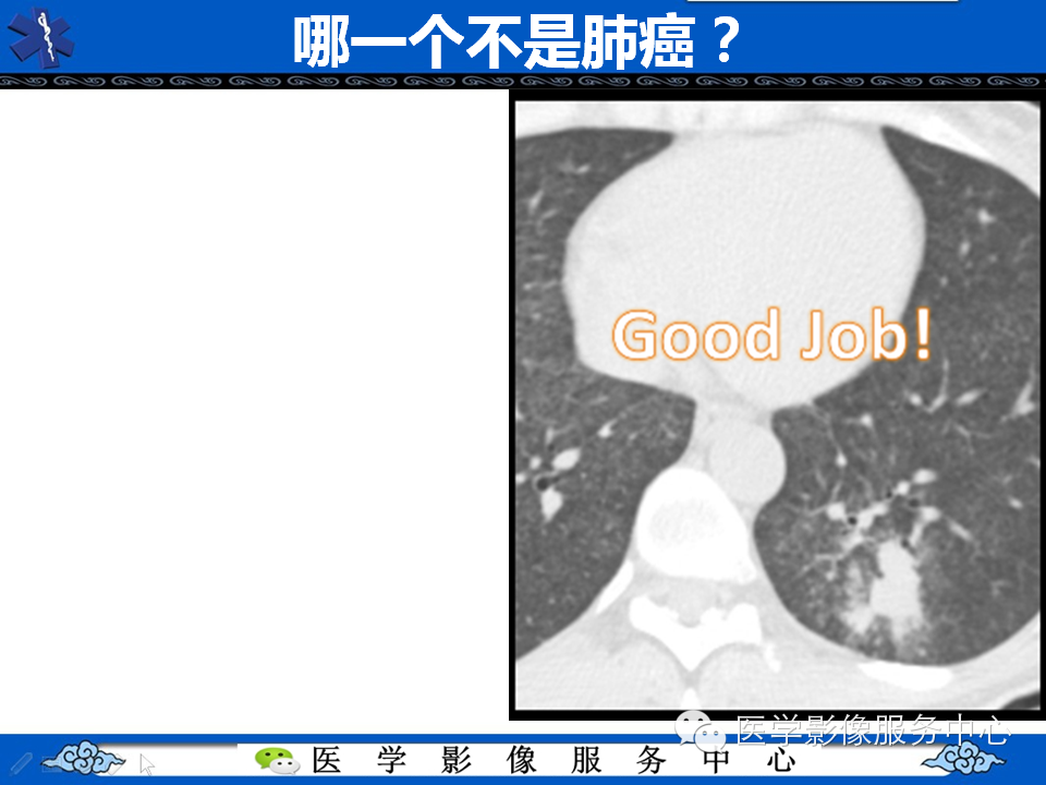 【考考你】哪一个不是肺癌？（共12组病例）
