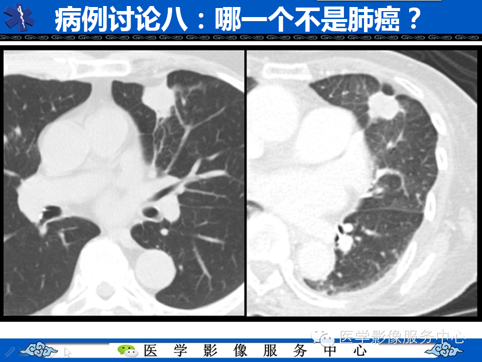 【考考你】哪一个不是肺癌？（共12组病例）