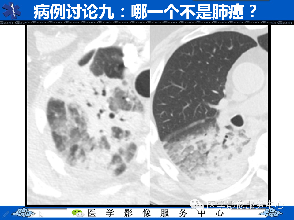 【考考你】哪一个不是肺癌？（共12组病例）