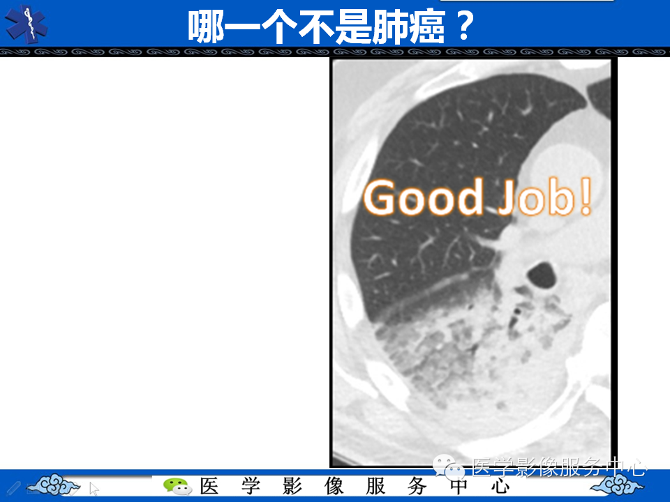 【考考你】哪一个不是肺癌？（共12组病例）