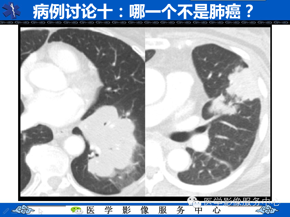 【考考你】哪一个不是肺癌？（共12组病例）