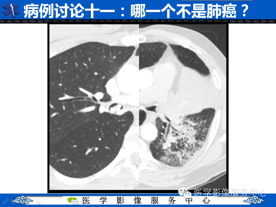 【考考你】哪一个不是肺癌？（共12组病例）