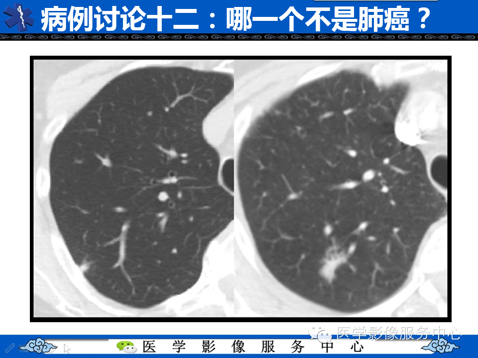 【考考你】哪一个不是肺癌？（共12组病例）