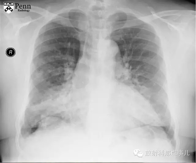 【病例学习】气管支气管巨大症（TBM）