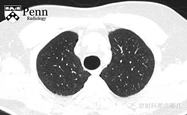 【病例学习】气管支气管巨大症（TBM）