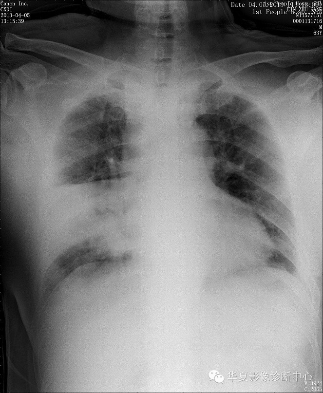 【病例学习】甲型H7N9禽流感一例