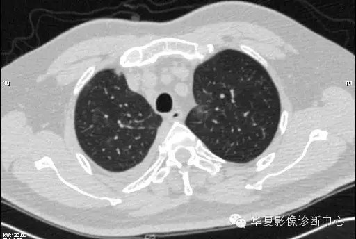 【病例学习】甲型H7N9禽流感一例