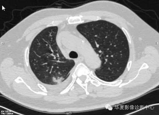 【病例学习】甲型H7N9禽流感一例